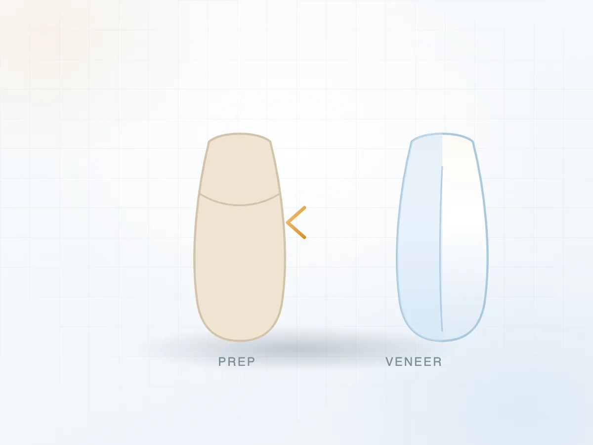 Veneer sứ siêu mỏng